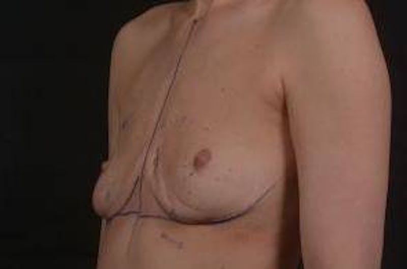 Aesthetic Breast Revision Before & After Gallery - Patient 136019 - Image 7