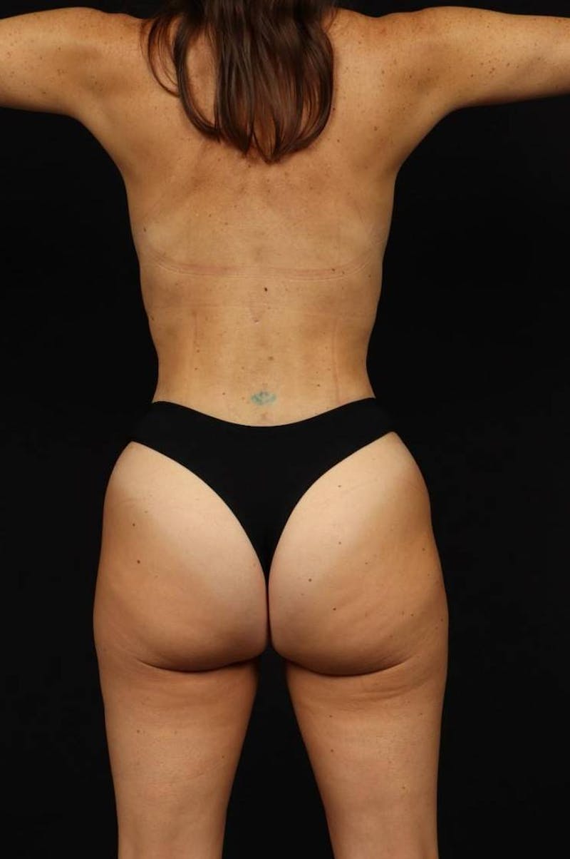 Mommy Makeover Before & After Gallery - Patient 208764 - Image 12