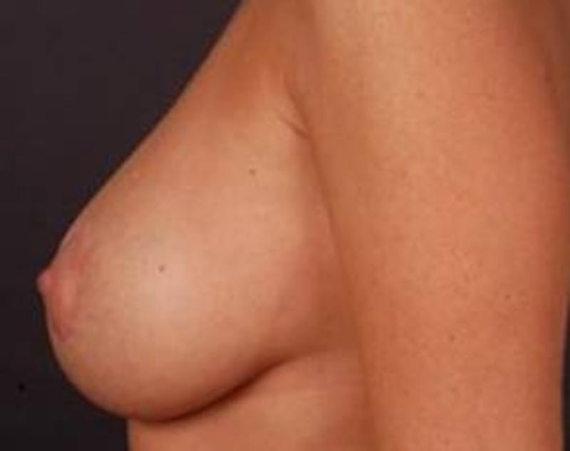 Mastopexy Before & After Gallery - Patient 271546 - Image 4