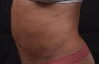 360 Liposuction Before & After Gallery - Patient 124298 - Image 8