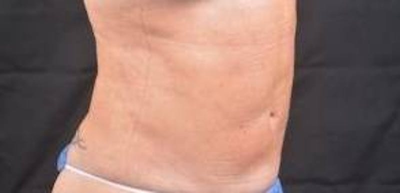 360 Liposuction Before & After Gallery - Patient 124298 - Image 9