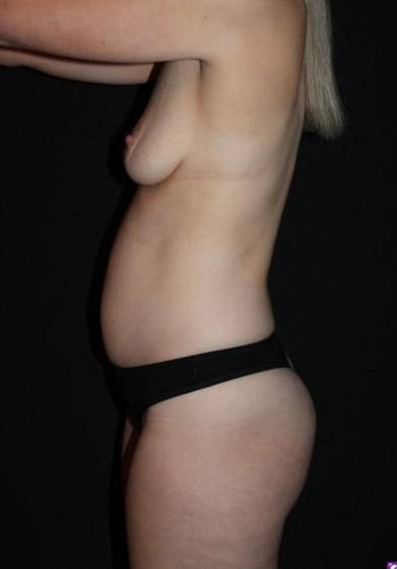 Mommy Makeover Before & After Gallery - Patient 371398 - Image 5