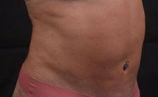 360 Liposuction Before & After Gallery - Patient 124298 - Image 10