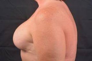 Immediate Breast Reconstruction – Skin Sparing Before & After Gallery - Patient 311958 - Image 4