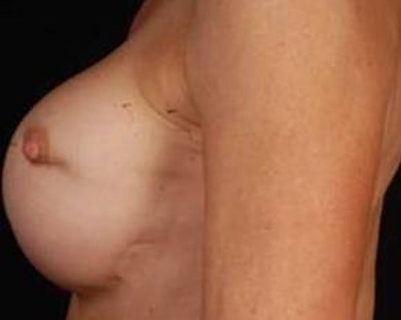 Reconstructive Breast Revision Before & After Gallery - Patient 128326 - Image 3