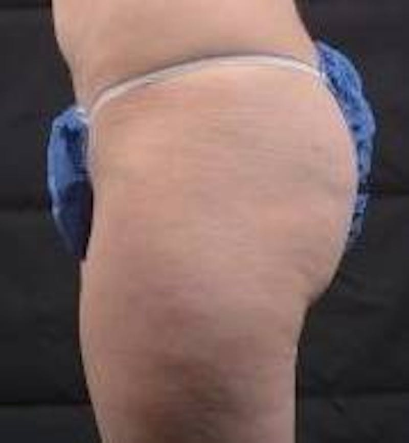 360 Liposuction Before & After Gallery - Patient 387019 - Image 3