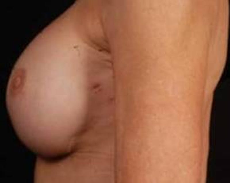 Reconstructive Breast Revision Before & After Gallery - Patient 128326 - Image 4