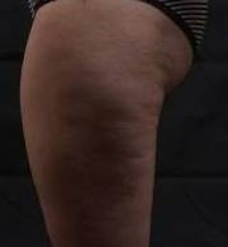 360 Liposuction Before & After Gallery - Patient 387019 - Image 4