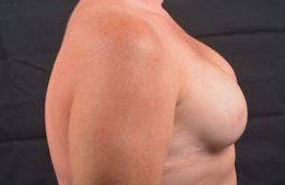 Immediate Breast Reconstruction – Skin Sparing Before & After Gallery - Patient 311958 - Image 6