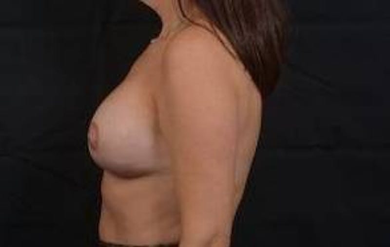 Breast Augmentation Mastopexy Before & After Gallery - Patient 403660 - Image 4