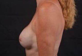 Immediate Breast Reconstruction – Nipple Sparing Before & After Gallery - Patient 113245 - Image 4