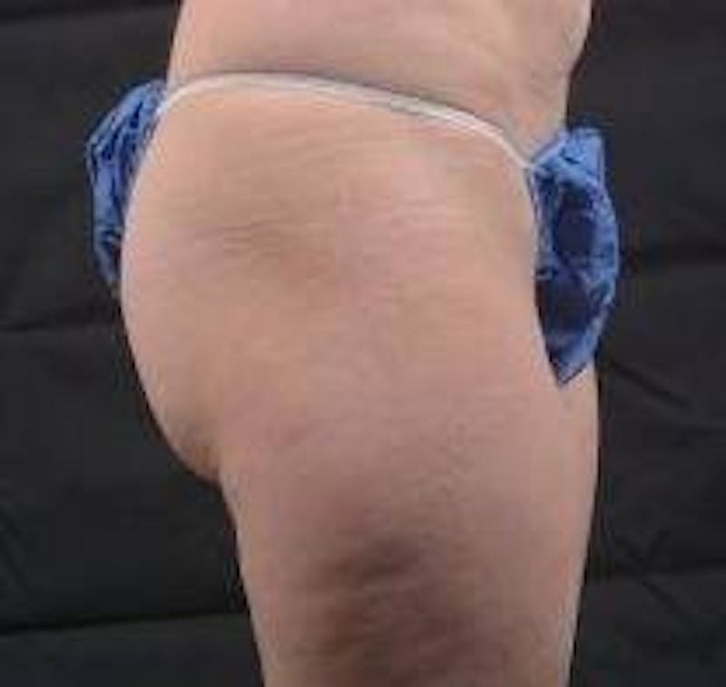 360 Liposuction Before & After Gallery - Patient 387019 - Image 5