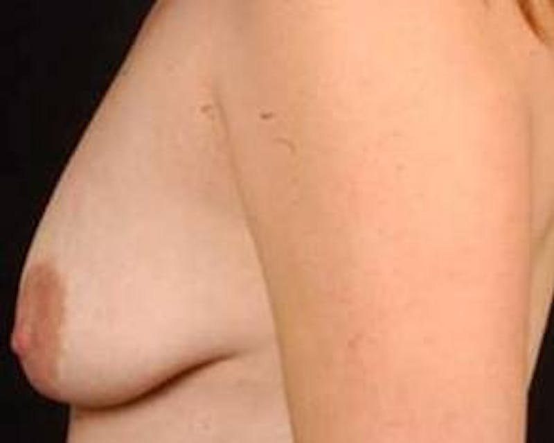 Mastopexy Before & After Gallery - Patient 316009 - Image 3
