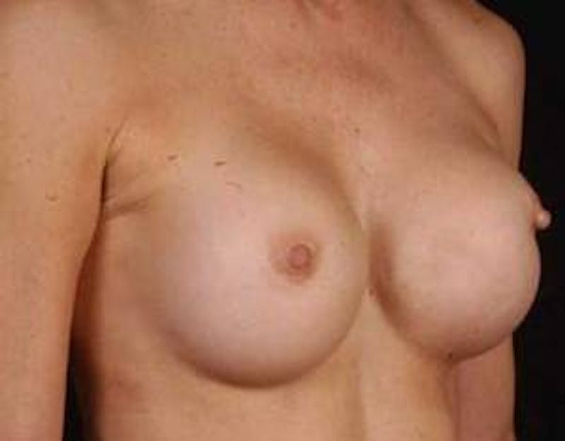 Reconstructive Breast Revision Before & After Gallery - Patient 128326 - Image 5