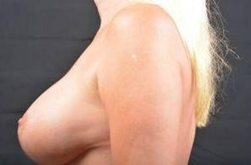 Aesthetic Breast Revision Before & After Gallery - Patient 269278 - Image 4