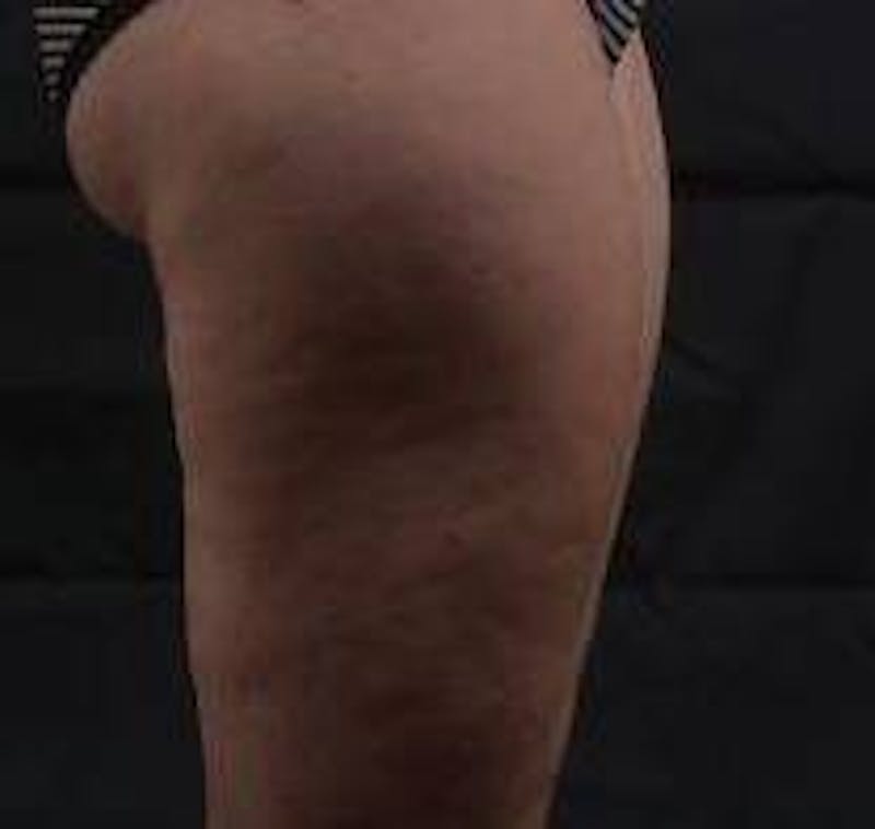 360 Liposuction Before & After Gallery - Patient 387019 - Image 6