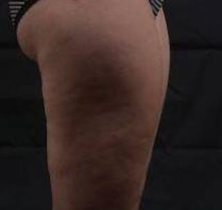 360 Liposuction Before & After Gallery - Patient 387019 - Image 6