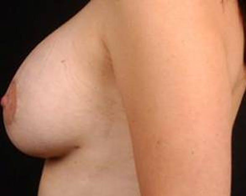 Mastopexy Before & After Gallery - Patient 316009 - Image 4