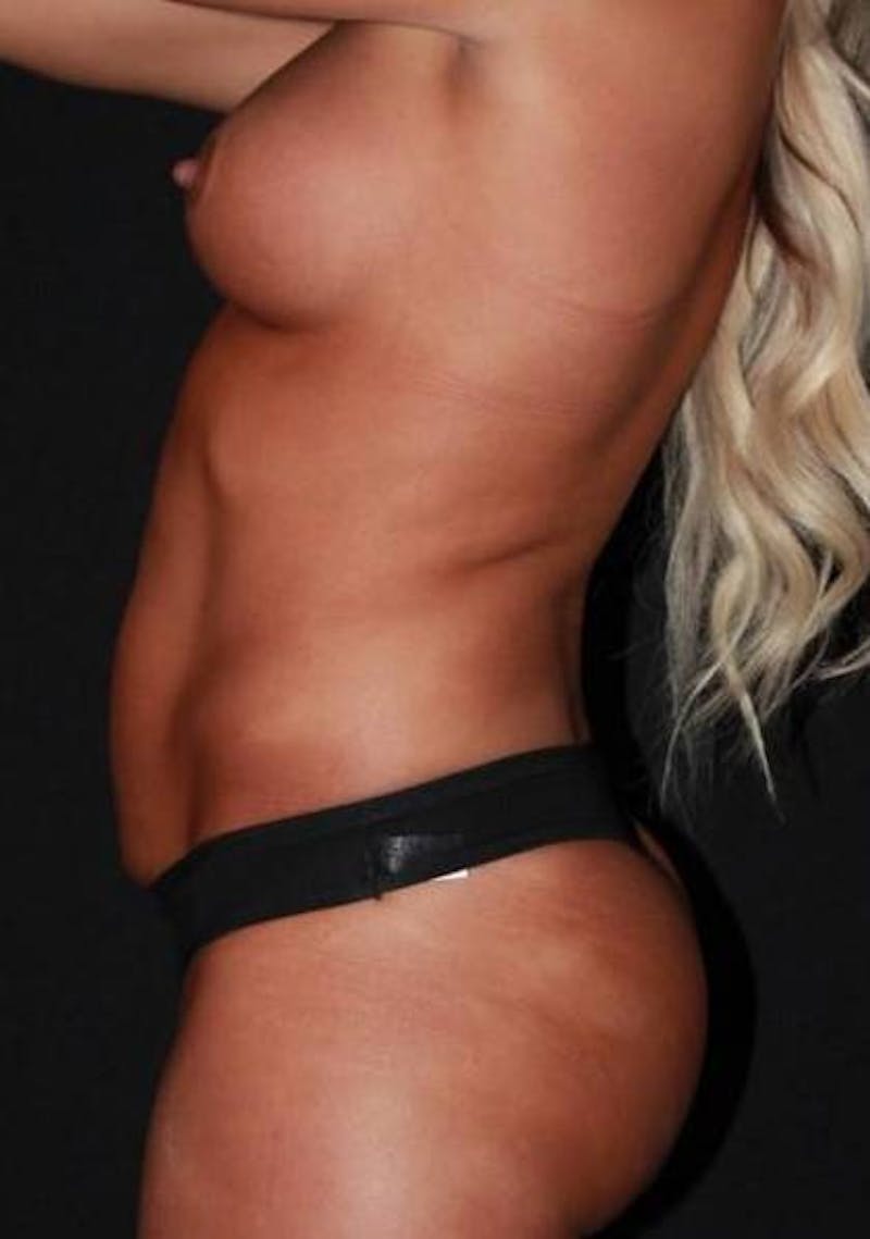 Abdominoplasty Before & After Gallery - Patient 257734 - Image 5