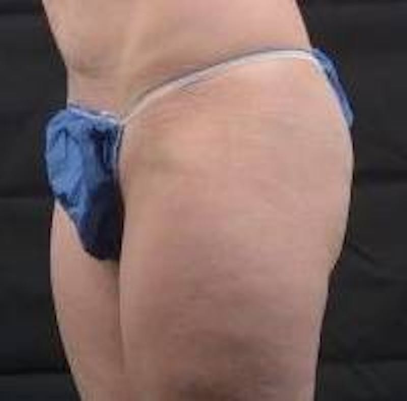 360 Liposuction Before & After Gallery - Patient 387019 - Image 7