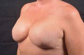 Immediate Breast Reconstruction – Skin Sparing Before & After Gallery - Patient 311958 - Image 8
