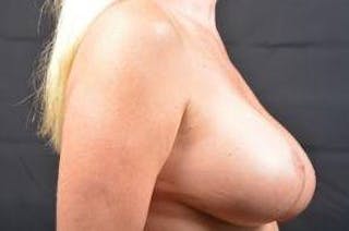 Aesthetic Breast Revision Before & After Gallery - Patient 269278 - Image 6