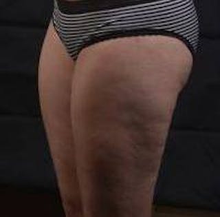 360 Liposuction Before & After Gallery - Patient 387019 - Image 8