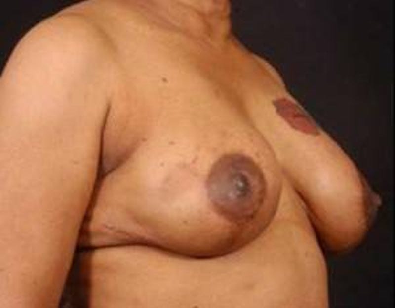 Reconstructive Breast Revision Before & After Gallery - Patient 281669 - Image 6