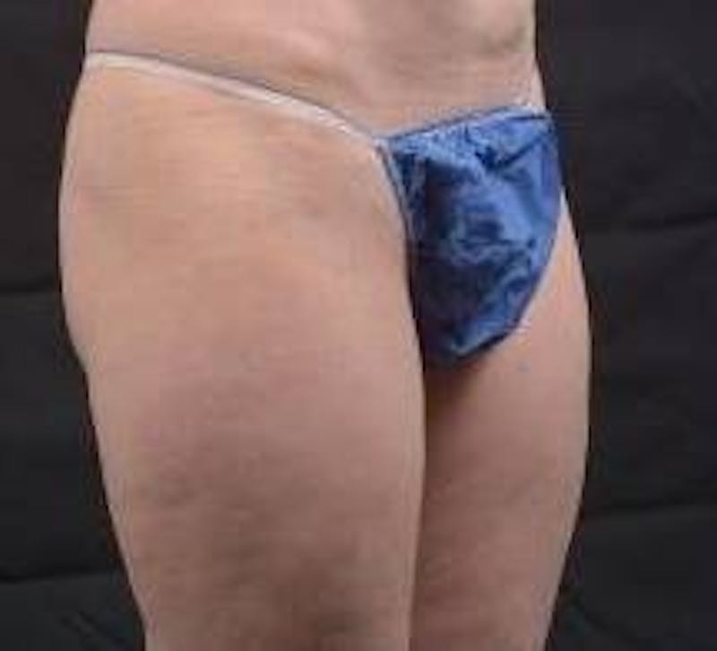 360 Liposuction Before & After Gallery - Patient 387019 - Image 9