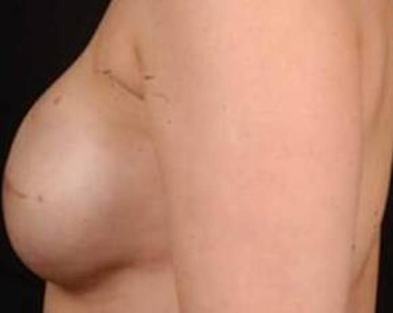 Reconstructive Breast Revision Before & After Gallery - Patient 926773 - Image 3