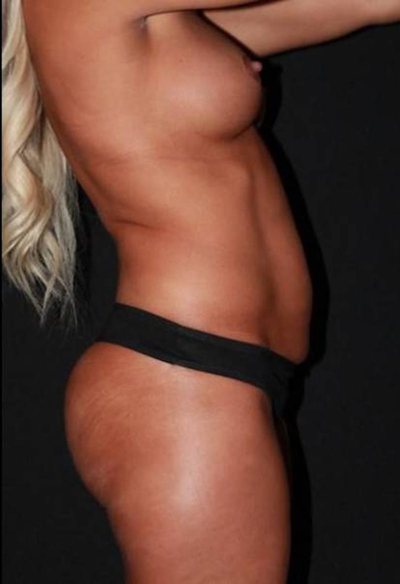 Abdominoplasty Before & After Gallery - Patient 257734 - Image 9