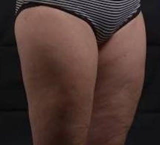 360 Liposuction Before & After Gallery - Patient 387019 - Image 10