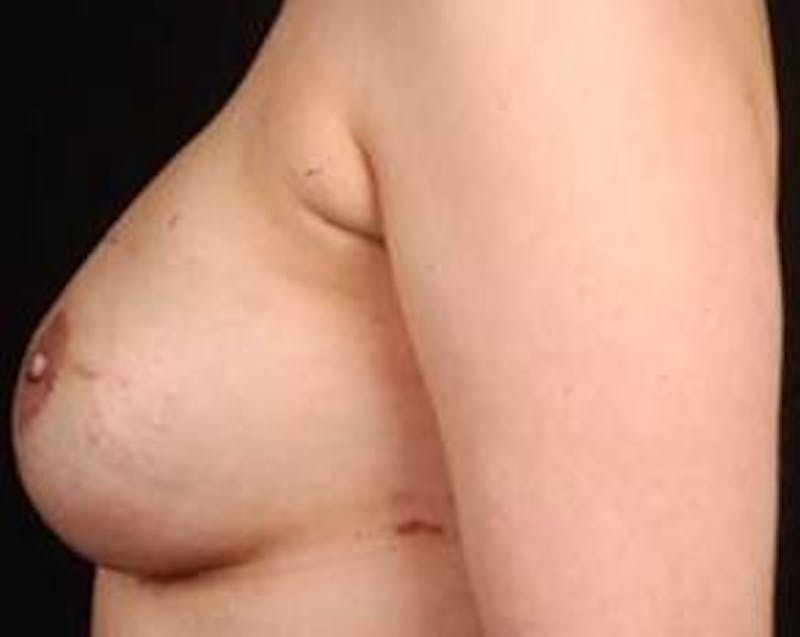 Reconstructive Breast Revision Before & After Gallery - Patient 926773 - Image 4