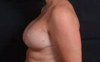 Immediate Breast Reconstruction – Skin Sparing Before & After Gallery - Patient 105579 - Image 4