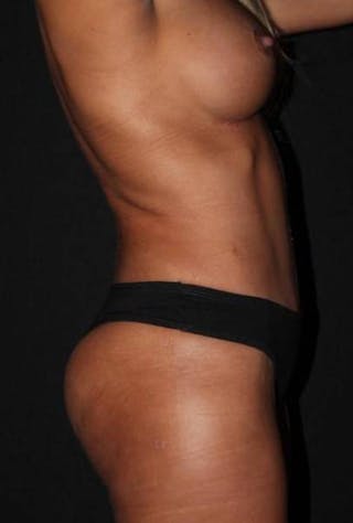 Abdominoplasty Before & After Gallery - Patient 257734 - Image 10