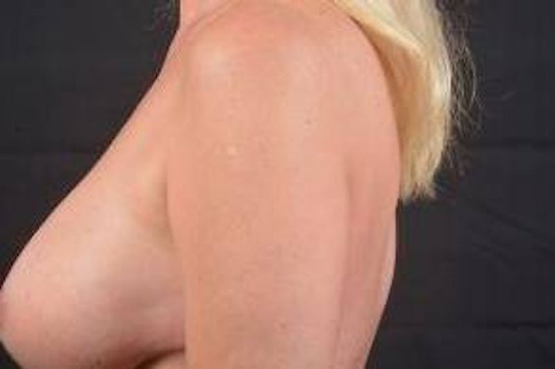 Breast Augmentation Mastopexy Before & After Gallery - Patient 421639 - Image 3