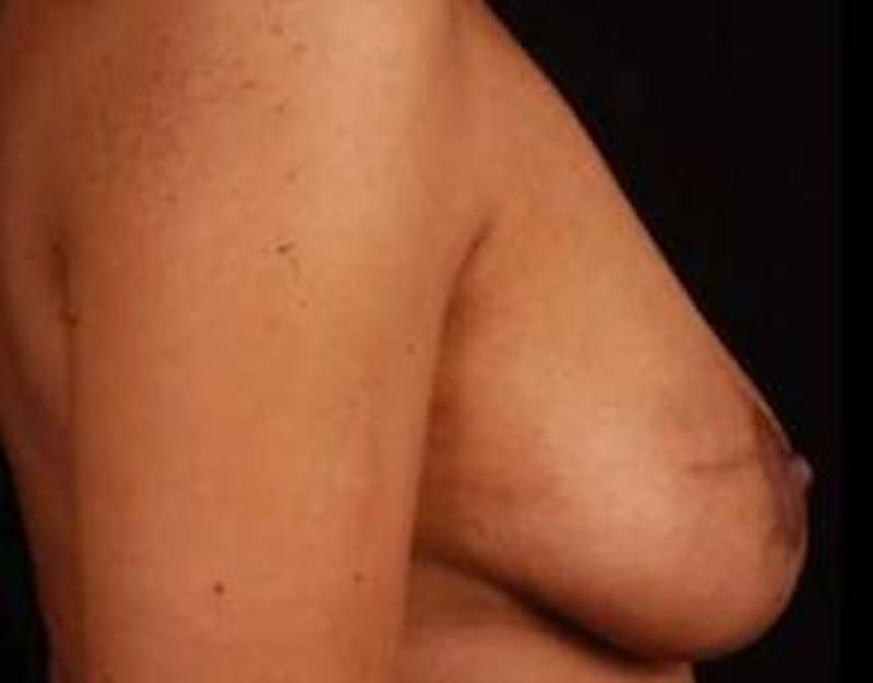 Mastopexy Before & After Gallery - Patient 133050 - Image 6