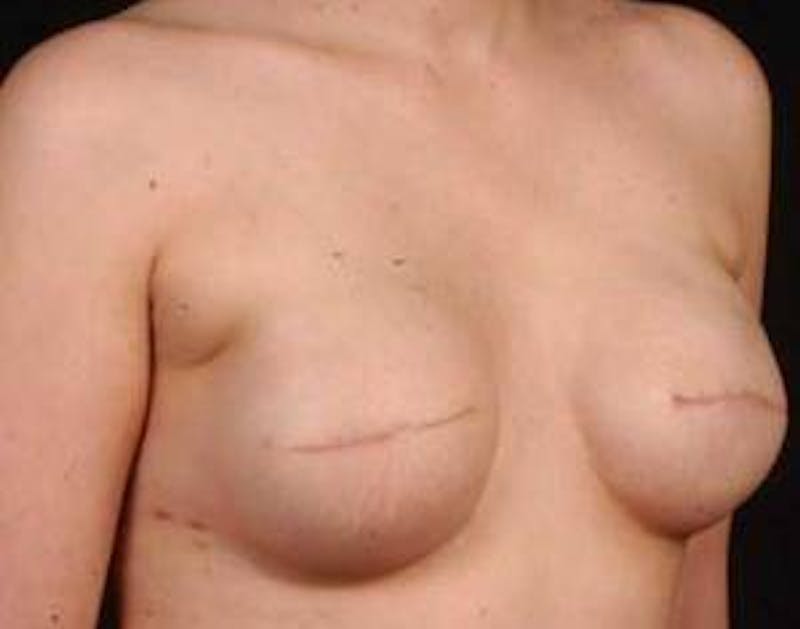 Reconstructive Breast Revision Before & After Gallery - Patient 926773 - Image 5