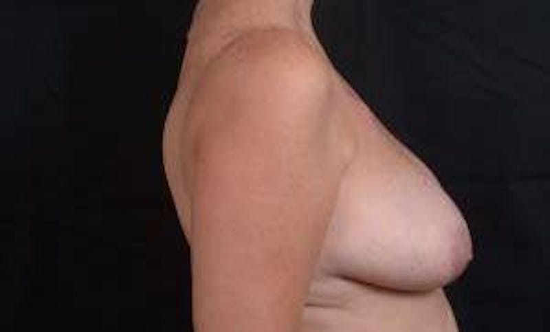 Immediate Breast Reconstruction – Skin Sparing Before & After Gallery - Patient 105579 - Image 5