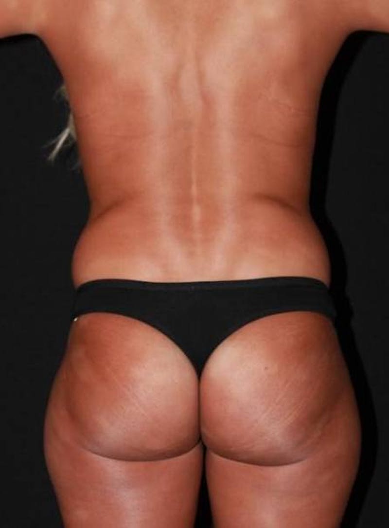 Abdominoplasty Before & After Gallery - Patient 257734 - Image 11
