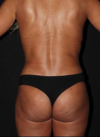 Abdominoplasty Before & After Gallery - Patient 257734 - Image 12