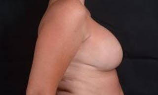 Immediate Breast Reconstruction – Skin Sparing Before & After Gallery - Patient 105579 - Image 6