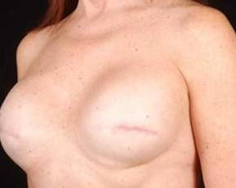 Reconstructive Breast Revision Before & After Gallery - Patient 213137 - Image 3