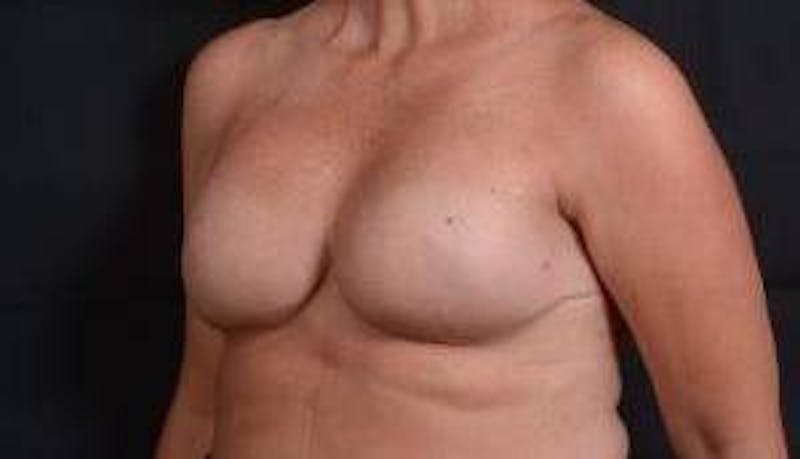 Immediate Breast Reconstruction – Skin Sparing Before & After Gallery - Patient 105579 - Image 8