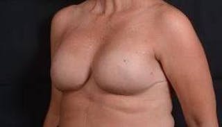 Immediate Breast Reconstruction – Skin Sparing Before & After Gallery - Patient 105579 - Image 8