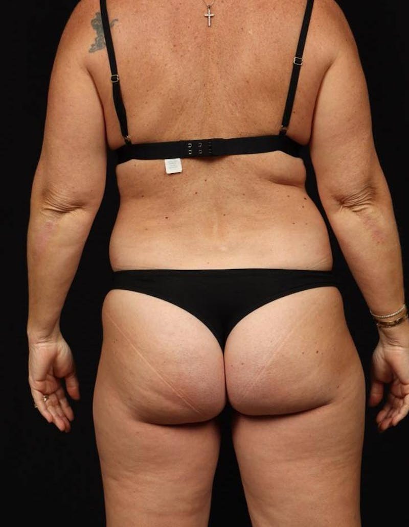Abdominoplasty Before & After Gallery - Patient 286922 - Image 11