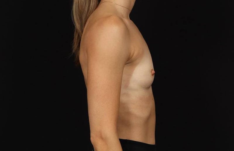 Breast Augmentation Silicone Gel Before & After Gallery - Patient 855110 - Image 9