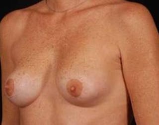 Mastopexy Before & After Gallery - Patient 252324 - Image 4
