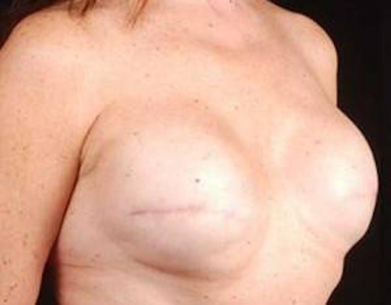 Reconstructive Breast Revision Before & After Gallery - Patient 213137 - Image 5
