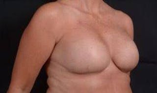 Immediate Breast Reconstruction – Skin Sparing Before & After Gallery - Patient 105579 - Image 10